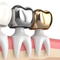 3d render of teeth with gold, amalgam and composite dental crown in gums