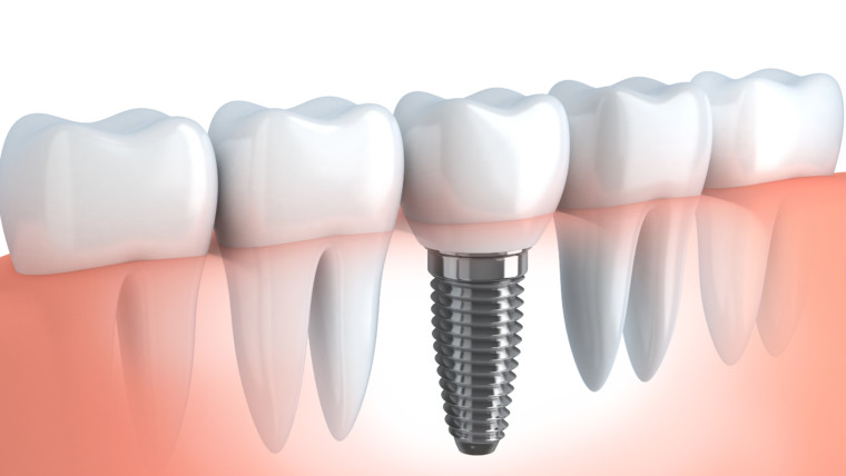Имплантация в стоматологии