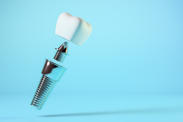 Dental implant, dental prosthesis. 3d rendering