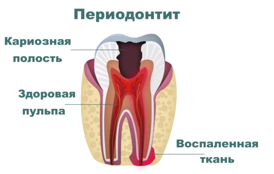 лечение периодонтита, схематичное изображение воспаления места соединения зуба.