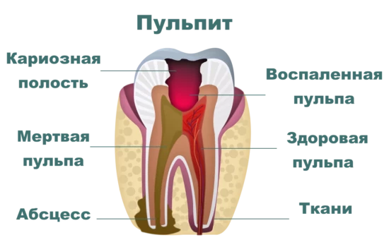 Схематично пульпит МЦ Медина+